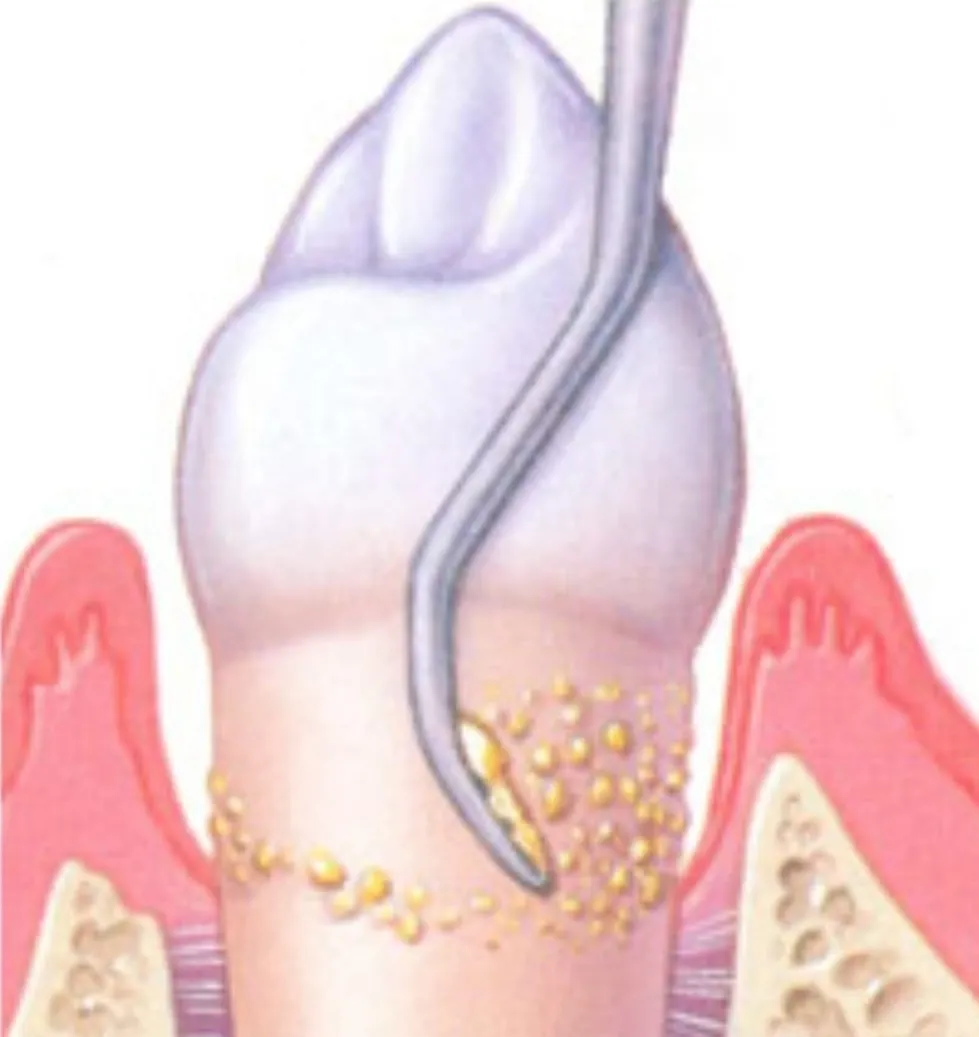 Parodontite